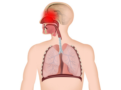 Sinusitis